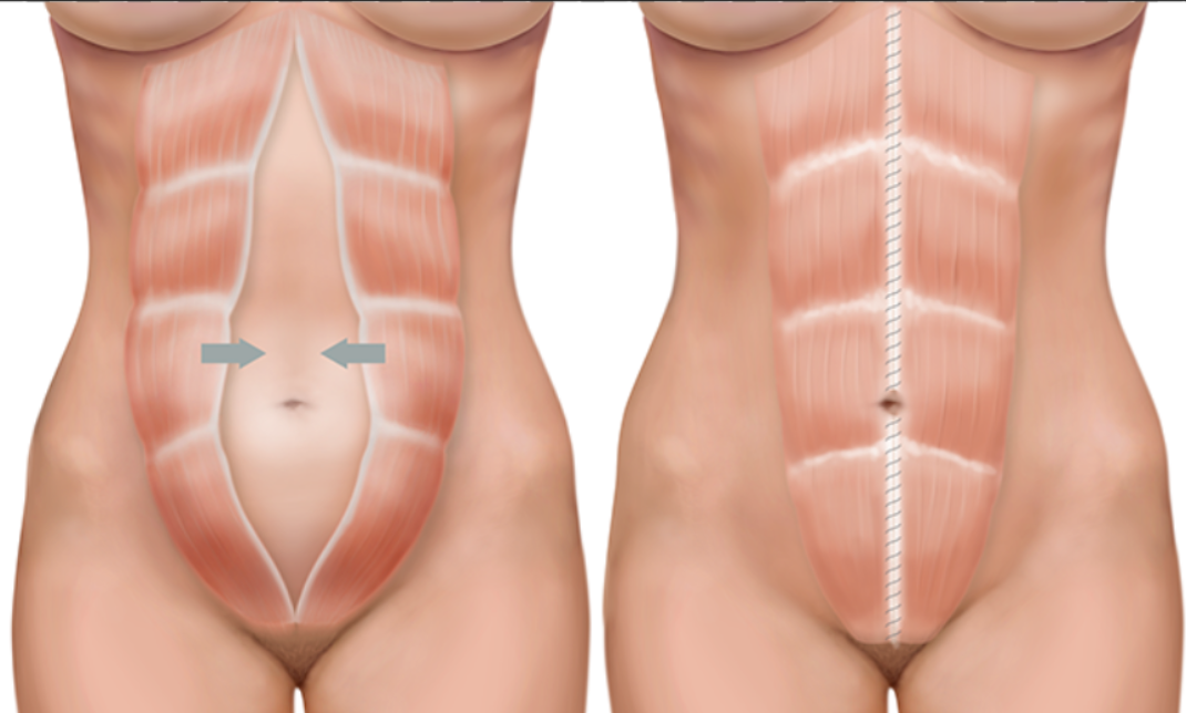 Ilustração anatômica comparando abdome com diástase do músculo reto abdominal e abdome após correção cirúrgica